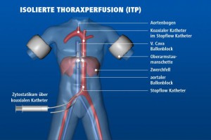 Isolierte Thoraxperfusion