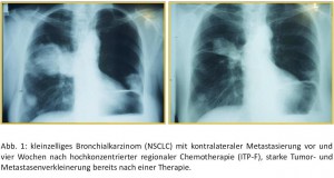 Röntgenbil nichtkleinzelliges Bronchialkarzinom